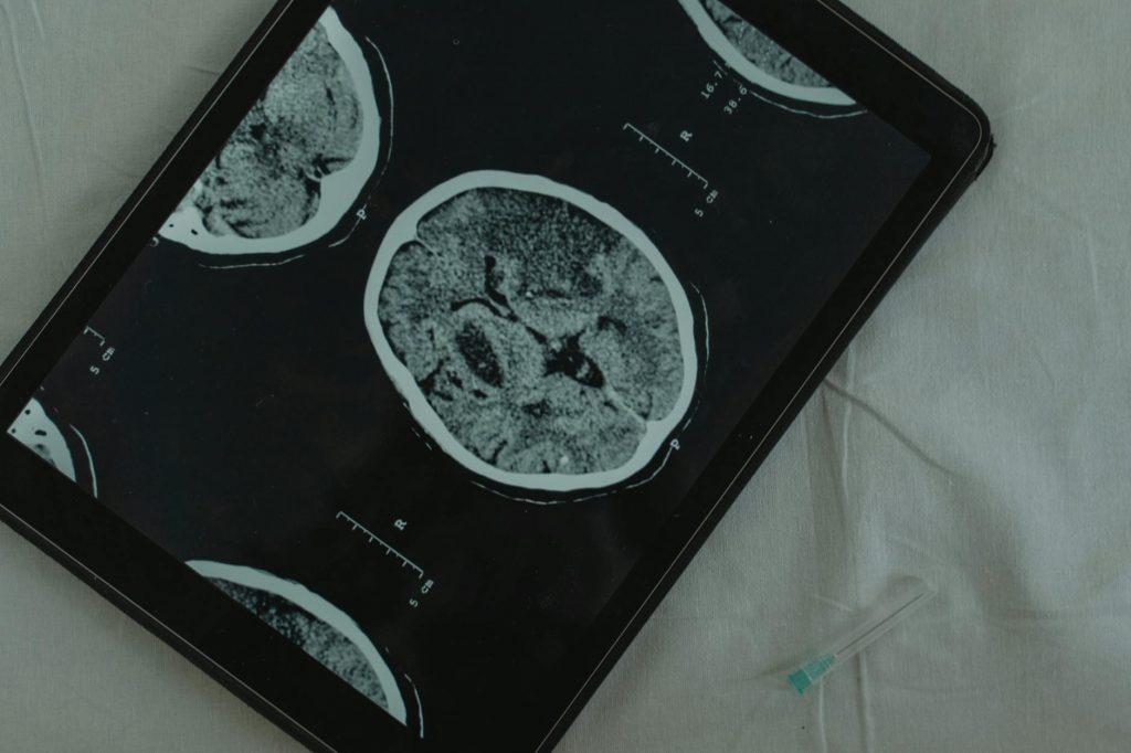 India Unites Against MS Diagnostic Delays