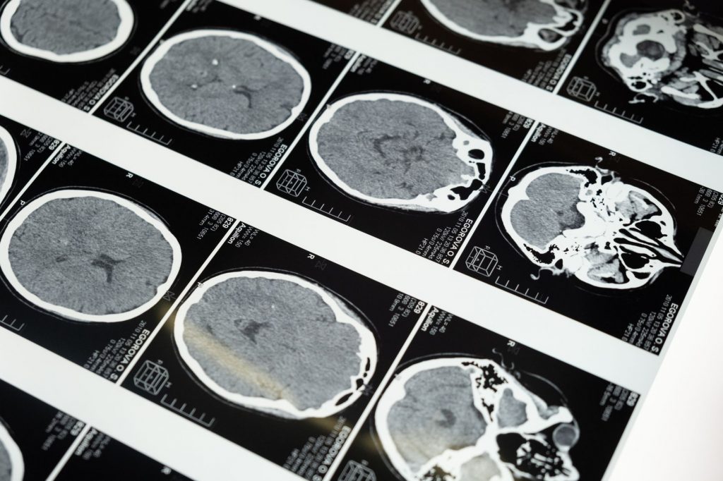 Brain Tumour