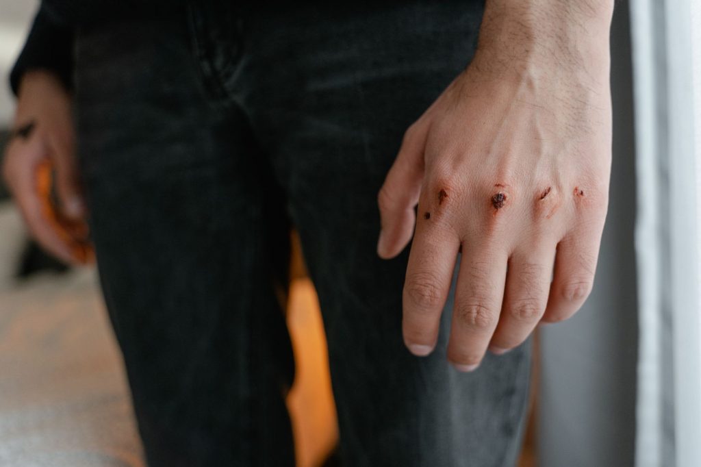 Pellet Wounds on ‘Cockroach’ Protesters Raise Eyebrows